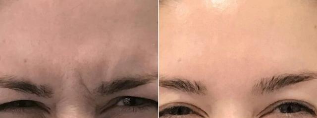 Botox result at Body+Beauty Lab in Philadelphia, PA