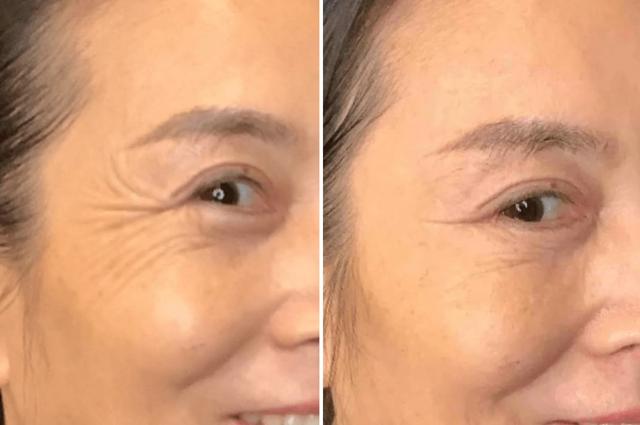 Botox result at Body+Beauty Lab in Philadelphia, PA