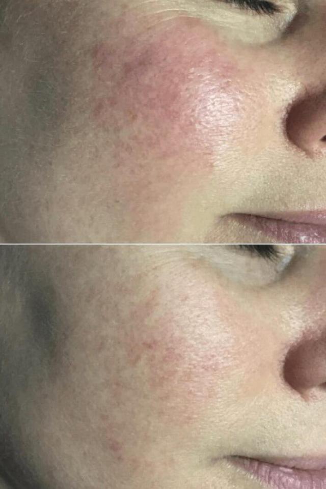 Chemical Peel result at Body+Beauty Lab in Philadelphia, PA