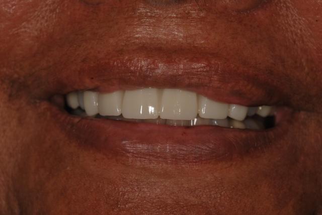 Smile Makeover after at Vitality Dental in Plano, TX