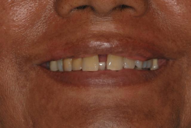 Smile Makeover before at Vitality Dental in Plano, TX
