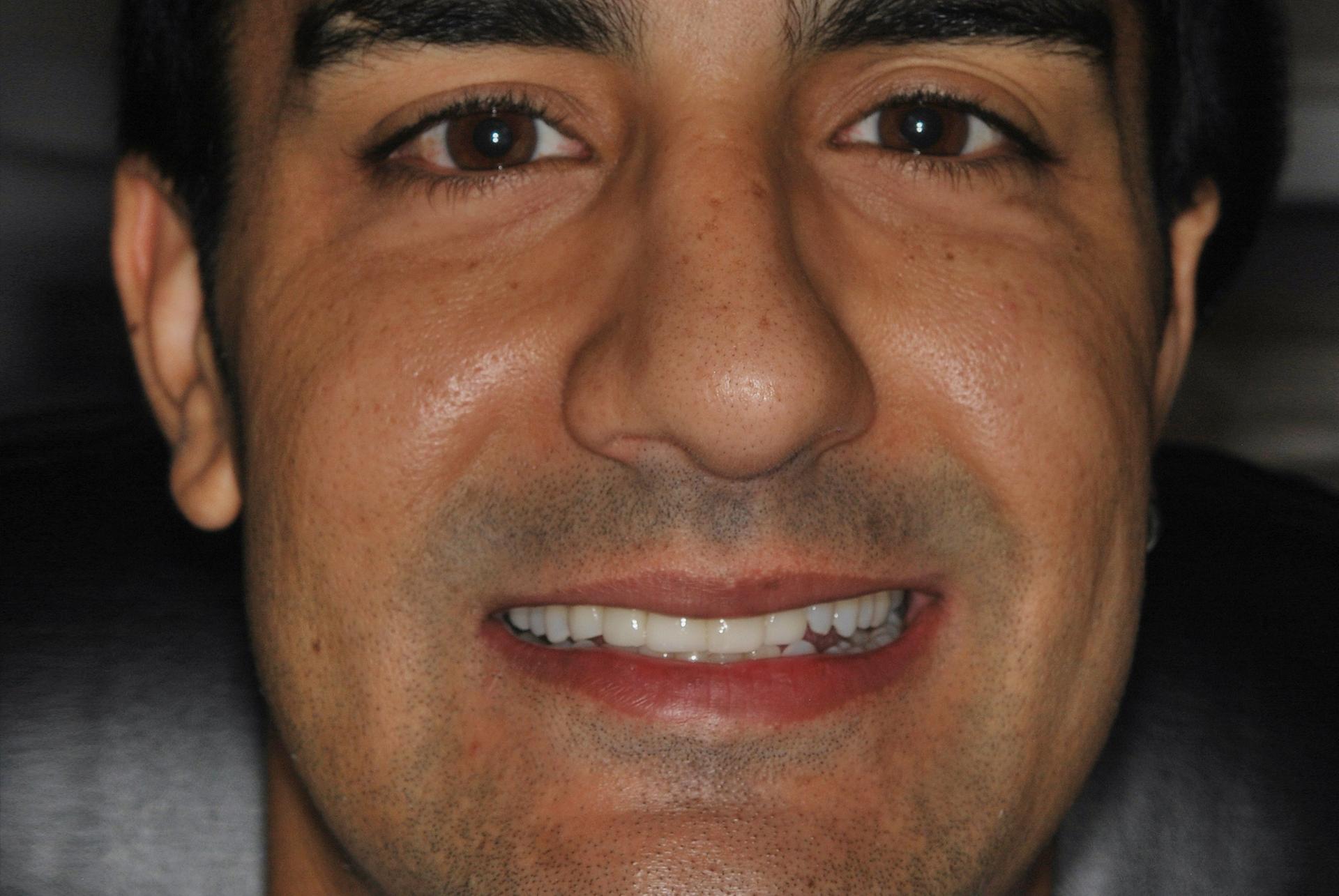 Vitality Dental smile makeover after — Plano, TX