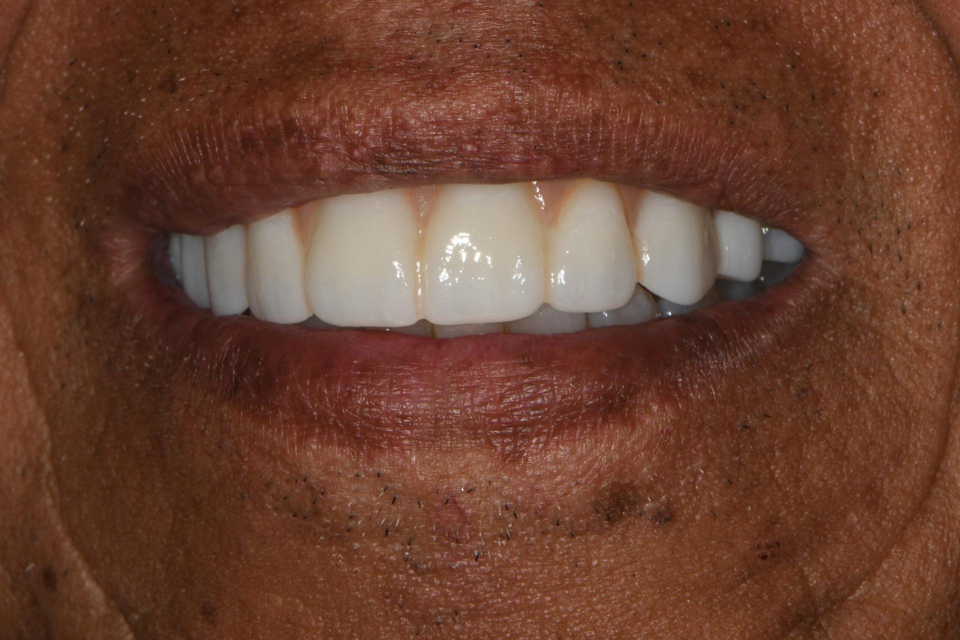 Vitality Dental smile makeover after — Plano, TX