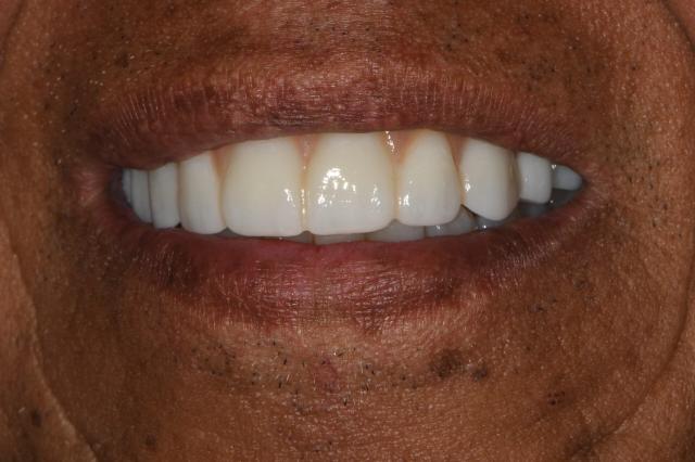 Smile Makeover after at Vitality Dental in Plano, TX