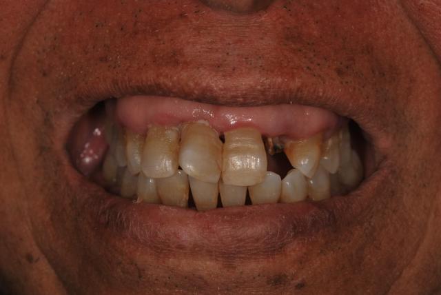 Smile Makeover before at Vitality Dental in Plano, TX