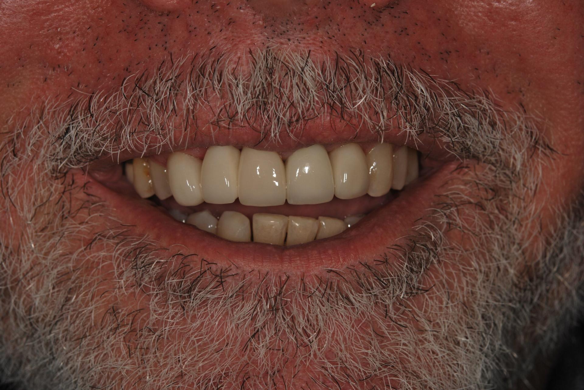 Vitality Dental dental crowns after — Plano, TX
