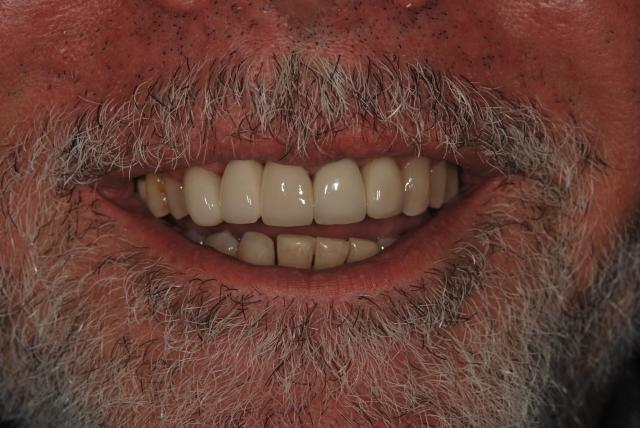 Dental Crowns after at Vitality Dental in Plano, TX