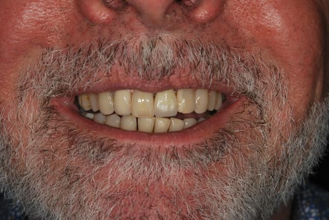 Dental Crowns before at Vitality Dental in Plano, TX