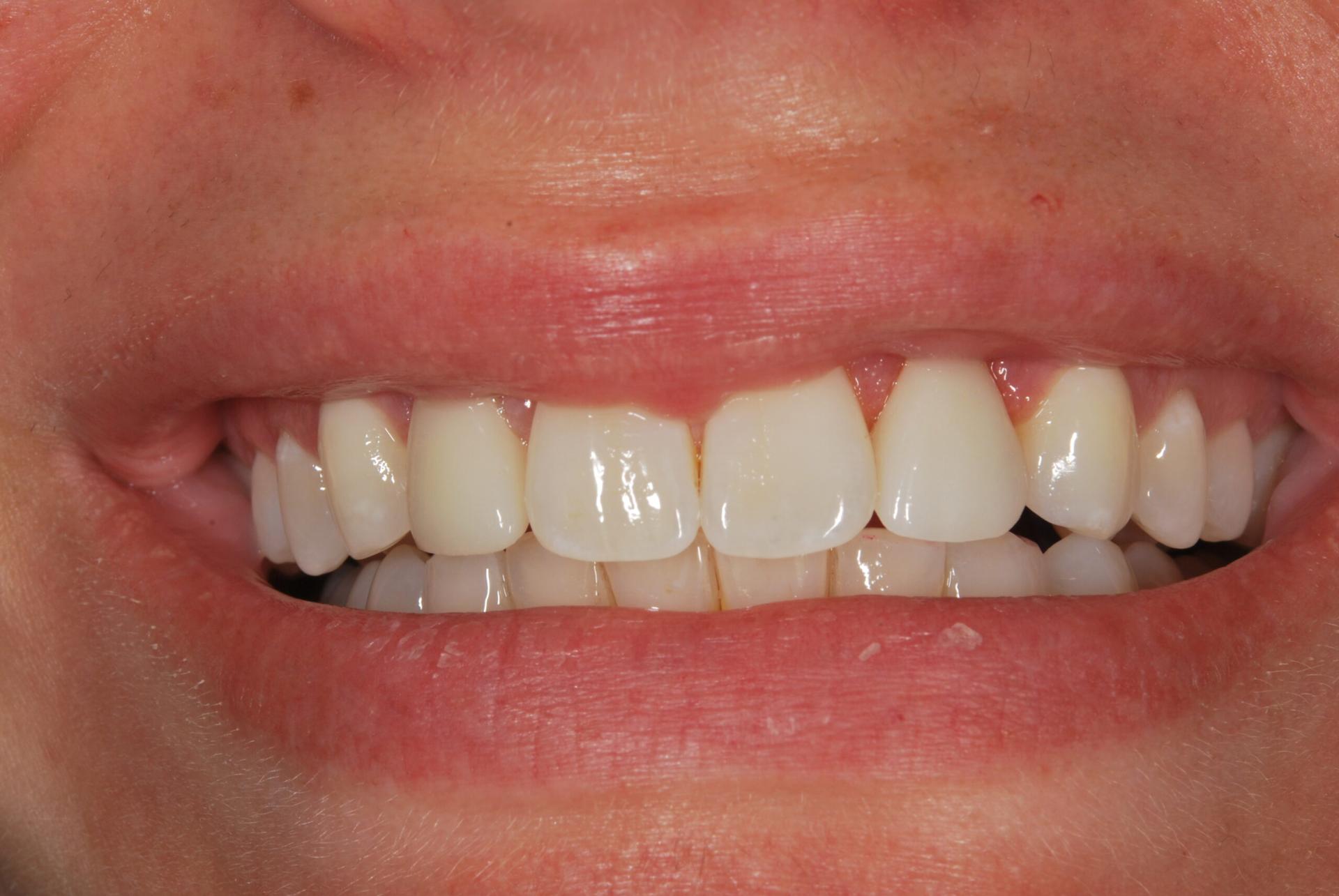 Vitality Dental dental crowns after — Plano, TX