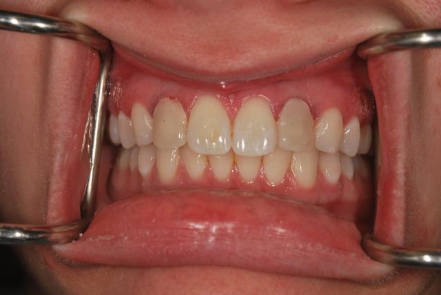 Dental Crowns before at Vitality Dental in Plano, TX