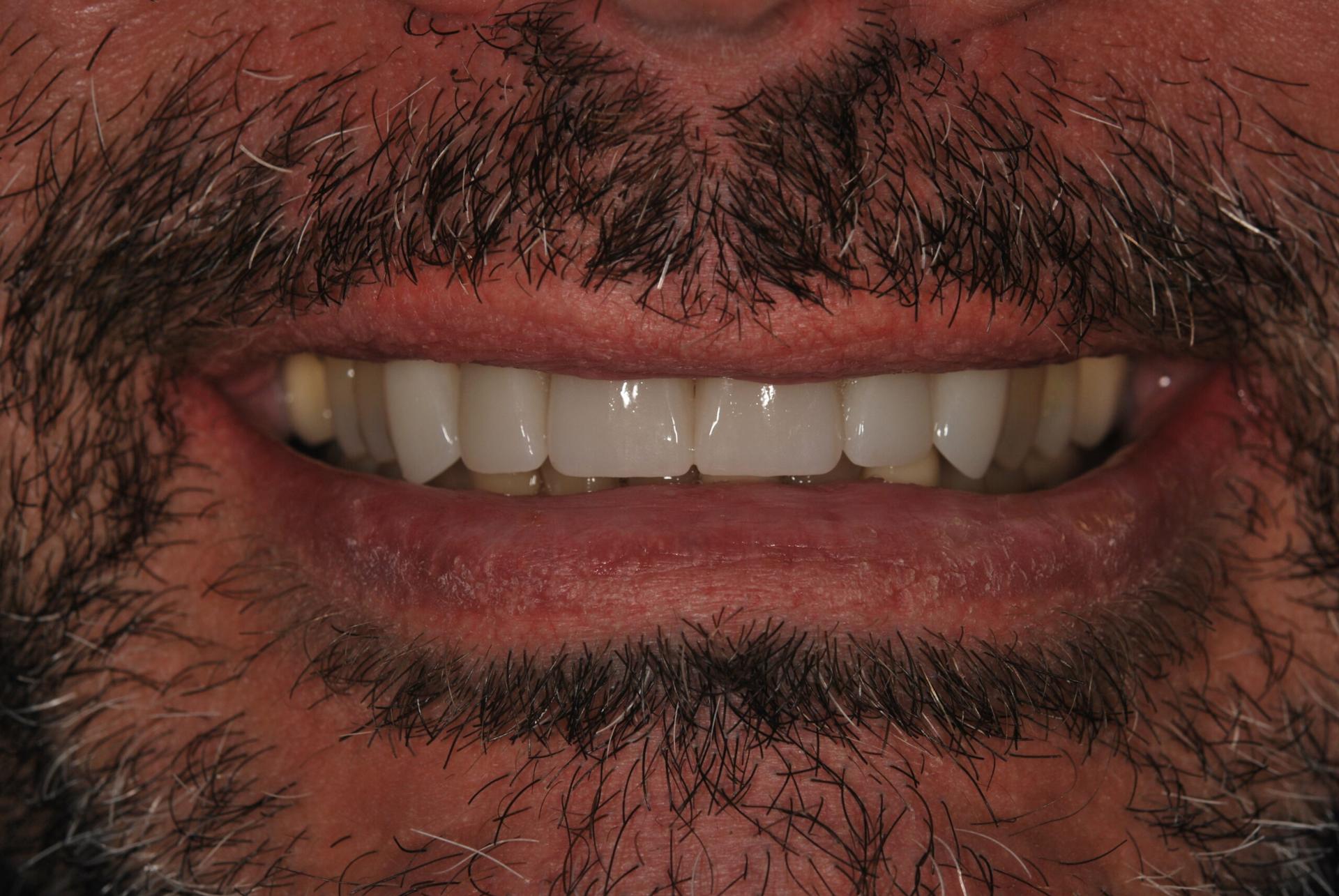 Vitality Dental dental crowns after — Plano, TX