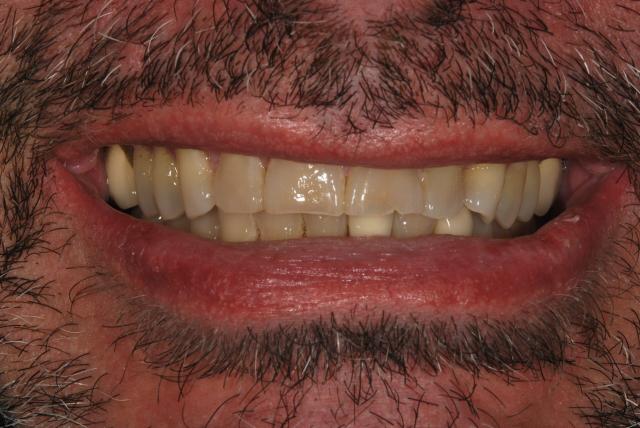 Dental Crowns before at Vitality Dental in Plano, TX