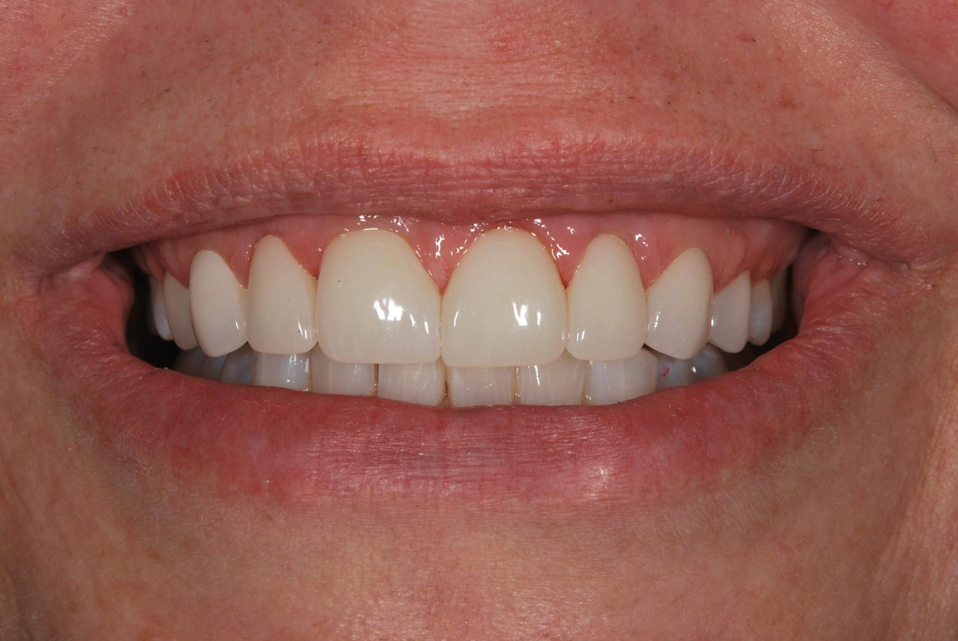 Vitality Dental smile makeover after — Plano, TX