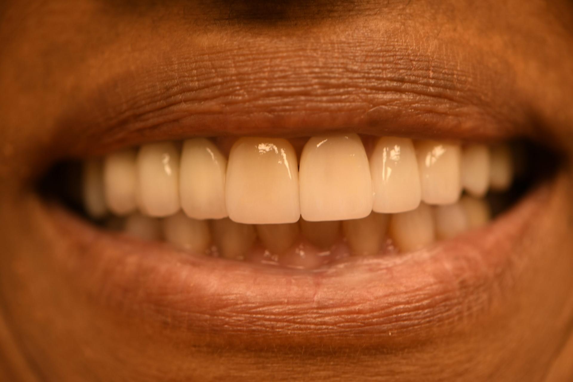 Vitality Dental dental crowns after — Plano, TX