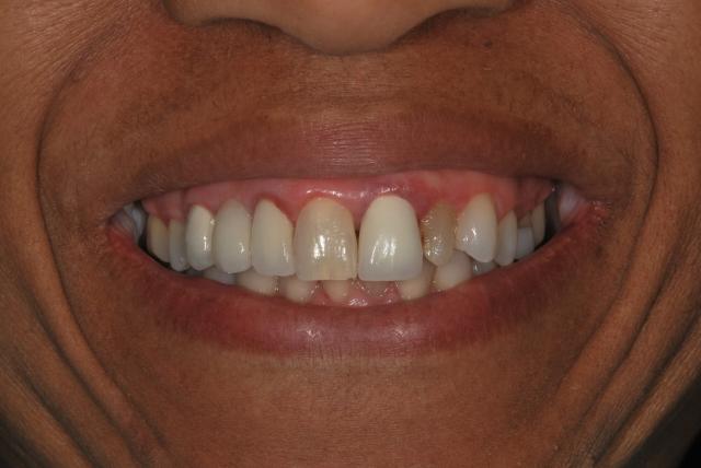 Dental Crowns before at Vitality Dental in Plano, TX