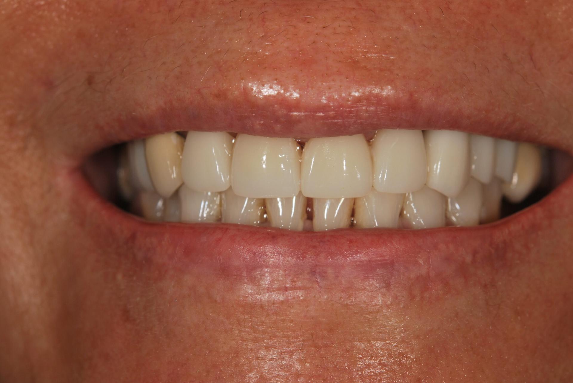 Vitality Dental dental crowns after — Plano, TX