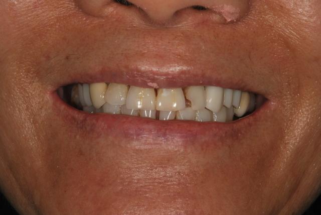 Dental Implants before at Vitality Dental in Plano, TX