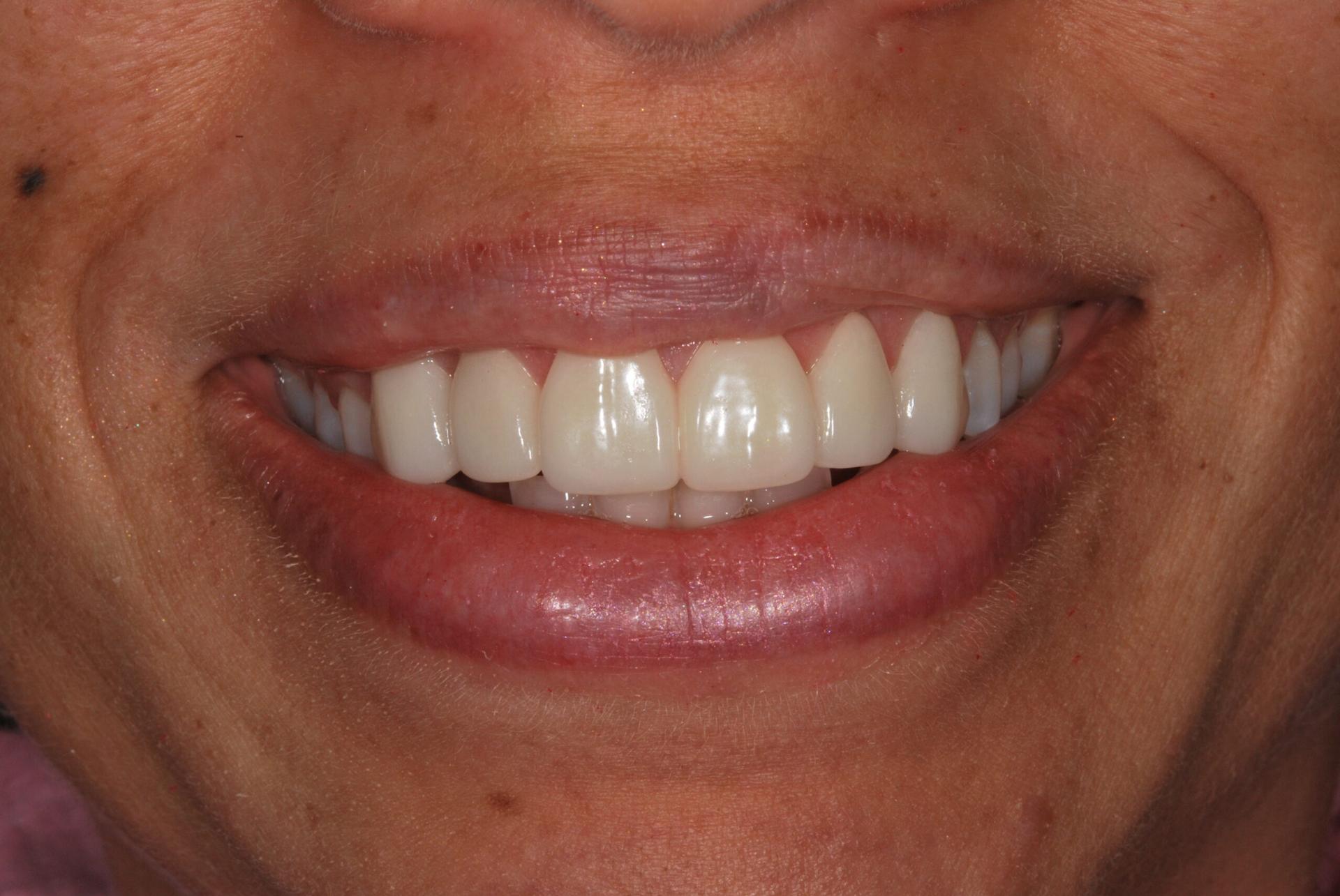 Vitality Dental veneers after — Plano, TX