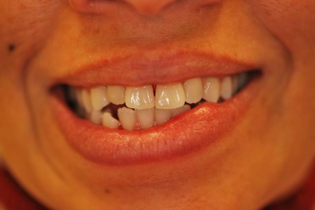 Dental Veneers before at Vitality Dental in Plano, TX
