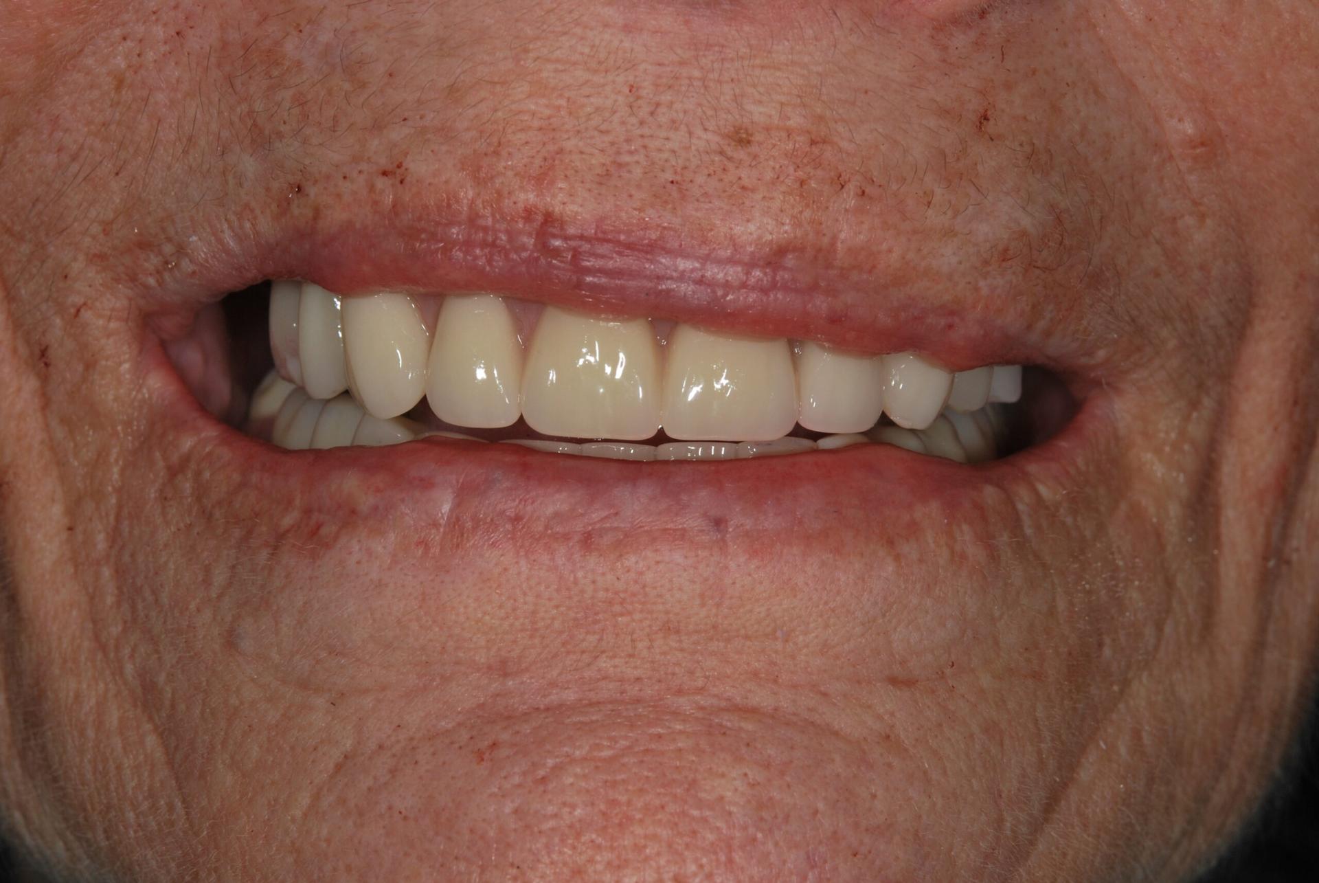 Vitality Dental smile makeover after — Plano, TX