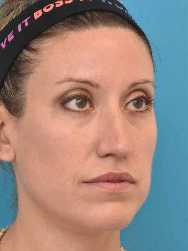 Jawline Filler before at Kirk Lozada, MD, Facial Plastic Surgery in Philadelphia, PA