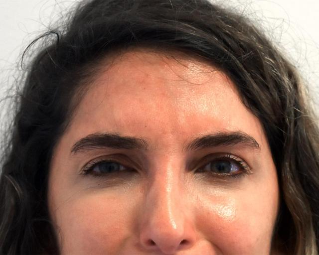 Botox after at Kirk Lozada, MD, Facial Plastic Surgery in Philadelphia, PA