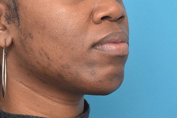 Chin Implant after at Kirk Lozada, MD, Facial Plastic Surgery in Philadelphia, PA
