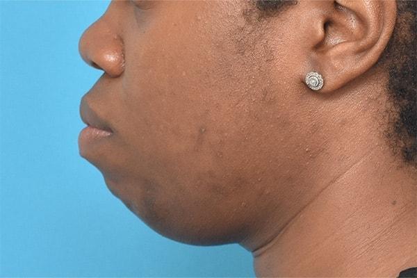 Chin Implant before at Kirk Lozada, MD, Facial Plastic Surgery in Philadelphia, PA