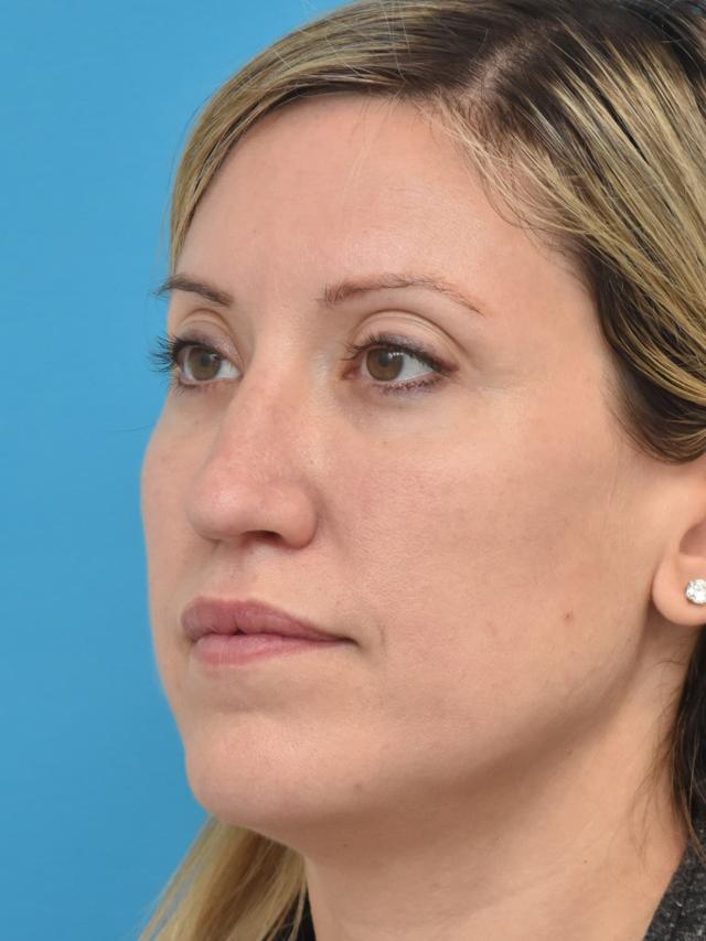 Jawline Filler after at Kirk Lozada, MD, Facial Plastic Surgery in Philadelphia, PA