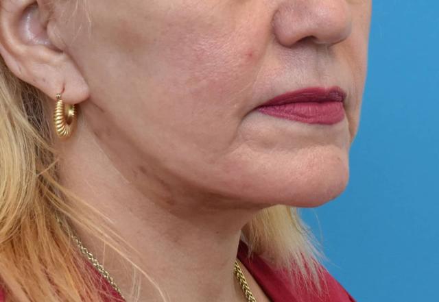 Facelift after at Kirk Lozada, MD, Facial Plastic Surgery in Philadelphia, PA