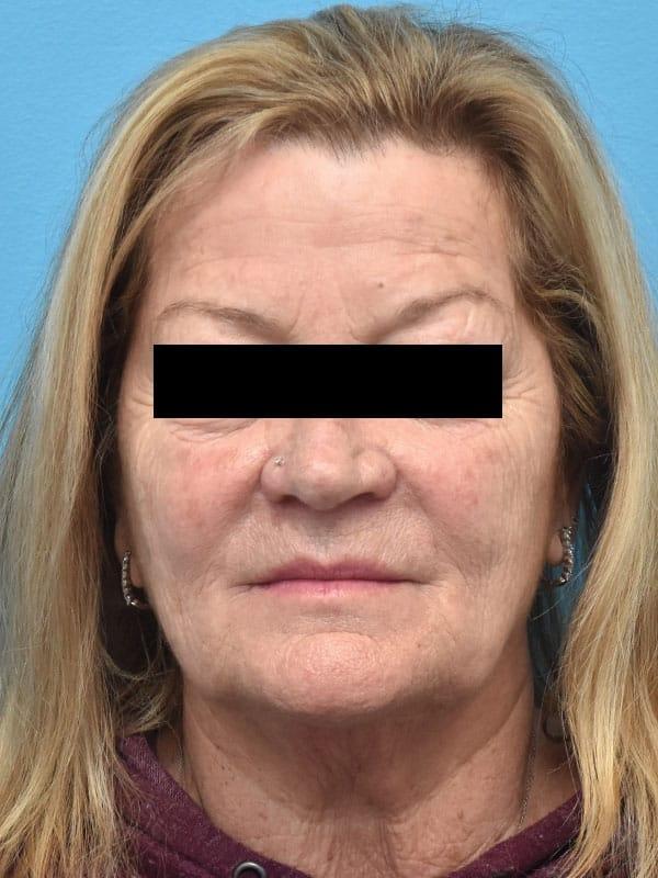 Facelift before at Kirk Lozada, MD, Facial Plastic Surgery in Philadelphia, PA