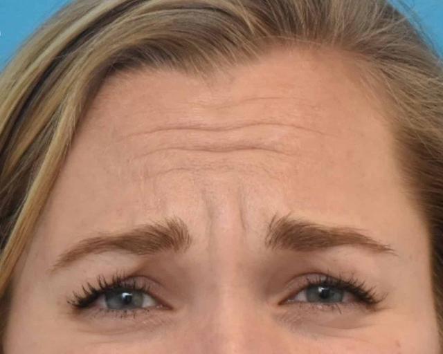 Botox before at Kirk Lozada, MD, Facial Plastic Surgery in Philadelphia, PA