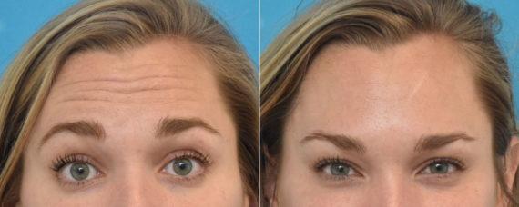 Botox result at Kirk Lozada, MD, Facial Plastic Surgery in Philadelphia, PA