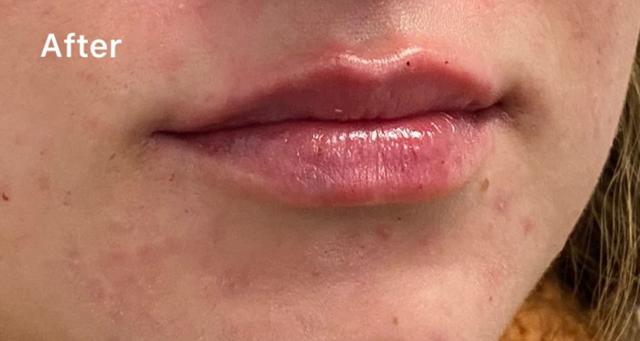 Lip Filler after at Kirk Lozada, MD, Facial Plastic Surgery in Philadelphia, PA