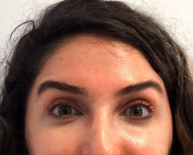 Botox after at Kirk Lozada, MD, Facial Plastic Surgery in Philadelphia, PA