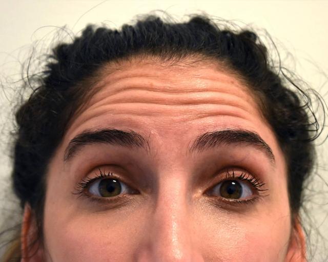 Botox before at Kirk Lozada, MD, Facial Plastic Surgery in Philadelphia, PA
