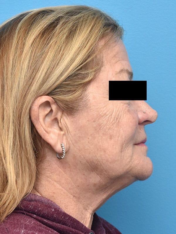 Facelift before at Kirk Lozada, MD, Facial Plastic Surgery in Philadelphia, PA