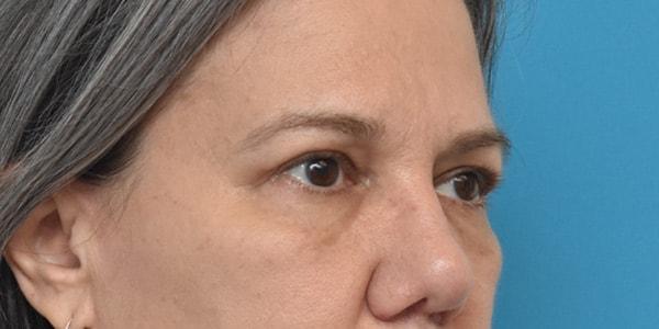 Brow Lift after at Kirk Lozada, MD, Facial Plastic Surgery in Philadelphia, PA