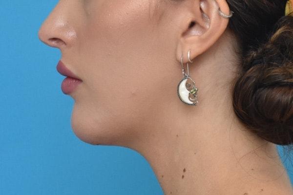Chin Implant after at Kirk Lozada, MD, Facial Plastic Surgery in Philadelphia, PA