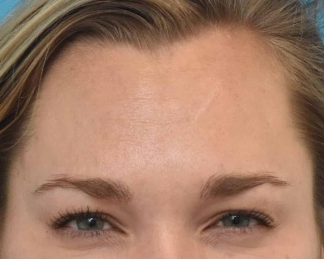 Botox after at Kirk Lozada, MD, Facial Plastic Surgery in Philadelphia, PA