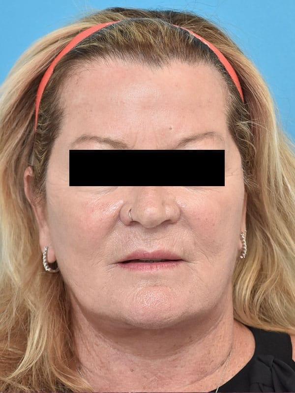Kirk Lozada, MD, Facial Plastic Surgery facelift after — Philadelphia, PA