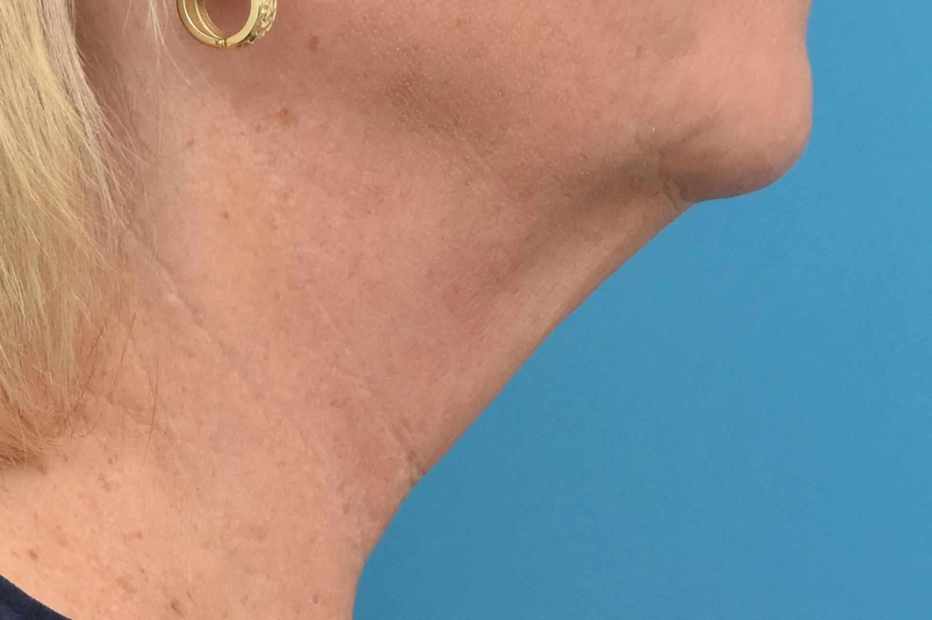 Kirk Lozada, MD, Facial Plastic Surgery facelift after — Philadelphia, PA