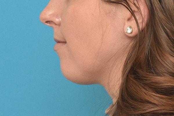 Chin Implant before at Kirk Lozada, MD, Facial Plastic Surgery in Philadelphia, PA