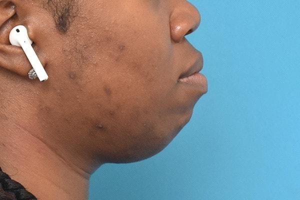 Chin Implant before at Kirk Lozada, MD, Facial Plastic Surgery in Philadelphia, PA