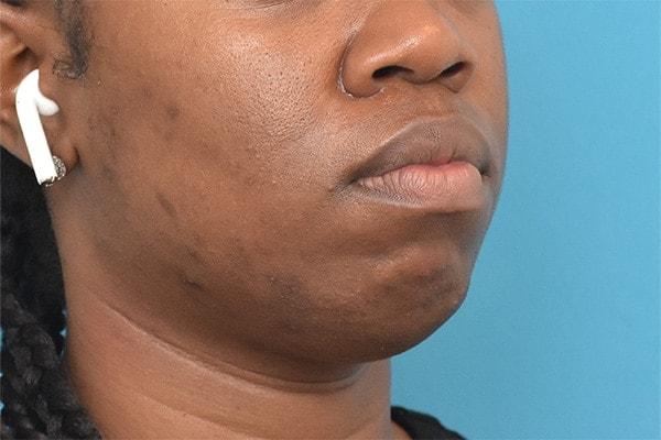 Chin Implant before at Kirk Lozada, MD, Facial Plastic Surgery in Philadelphia, PA