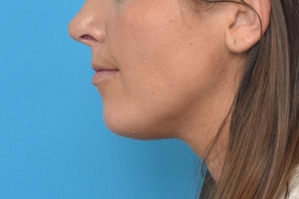 Chin Implant after at Kirk Lozada, MD, Facial Plastic Surgery in Philadelphia, PA