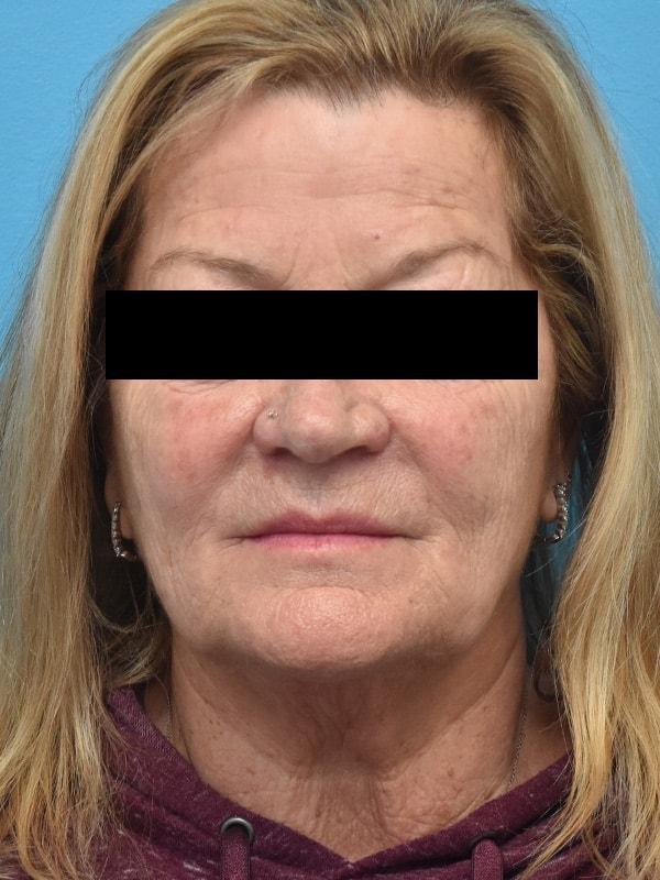Chemical Peel before at Kirk Lozada, MD, Facial Plastic Surgery in Philadelphia, PA