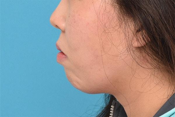 Chin Implant before at Kirk Lozada, MD, Facial Plastic Surgery in Philadelphia, PA