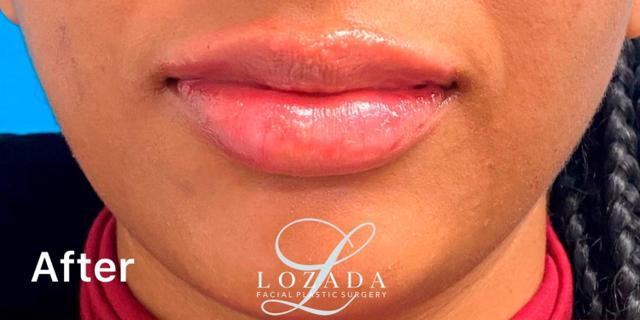 Lip Filler after at Kirk Lozada, MD, Facial Plastic Surgery in Philadelphia, PA