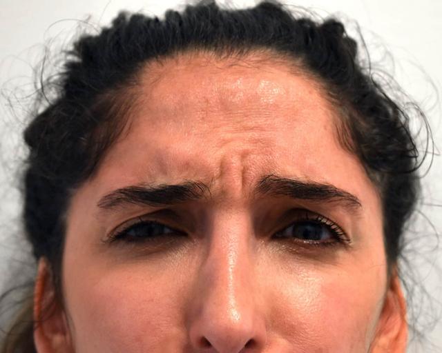 Botox before at Kirk Lozada, MD, Facial Plastic Surgery in Philadelphia, PA